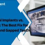 Dental Implants vs. Bonding